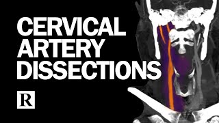 Cervical Arterial Dissections [upl. by Feucht]