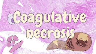 Coagulative necrosis  general pathology [upl. by Aleahpar]