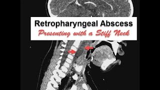 Neck Stiffness with Retropharyngeal Abscess [upl. by Anitroc]