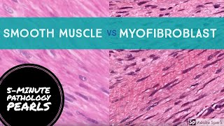 Myofibroblasts vs Smooth Muscle Made Easy 5Minute Pathology Pearls [upl. by Aleacin478]