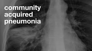 Community Acquired Pneumonia [upl. by Kuehnel712]