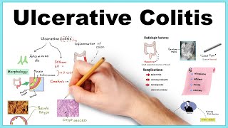 How Stelara ustekinumab Works in Crohn’s Disease [upl. by Emera35]