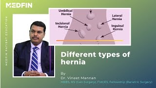 Types of Hernias [upl. by Haroved835]