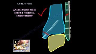 Lung Neuroendocrine Tumors Treatment with Robert Ramirez OD [upl. by Adyol715]