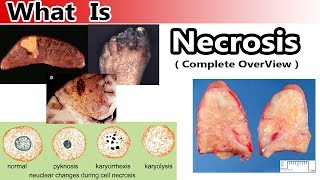 What is Necrosis  Complete Overview [upl. by Nimra179]