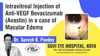 Intravitreal Injection of AntiVEGF Bevacizumab Avastin in a case of Macular Edemampg [upl. by Meredith]