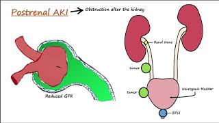 Acute Kidney Injury AKI  PrerenalIntrarenalPostrenal [upl. by Alrats]