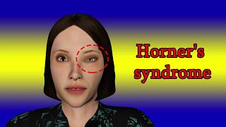 Horners syndrome  Symptoms and causes [upl. by Akemej]