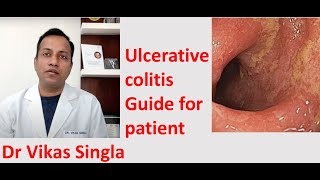 Ulcerative colitis Treatment and Symptoms अल्सरेटिव कोलाइटिस In Hindi Dr Vikas Singla [upl. by Frants47]