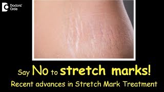 What laser treatment is best for stretch marks  Dr Urmila Nischal [upl. by Dijam147]