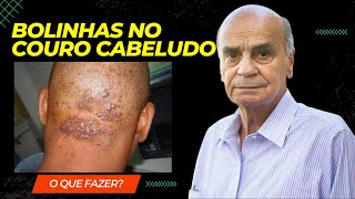 Foliculite no couro cabeludo Saiba como tratar [upl. by Frieder]