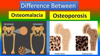 Osteroporosis and Osteomalacia [upl. by Aleihs326]