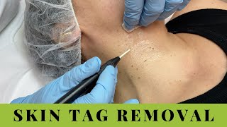 Skin Tags Removal on Neck and Underarms Quick easy no pain [upl. by Maggio328]