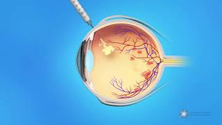 Eye Injections for Central Retinal Vein Occlusion CRVO [upl. by Mylo]