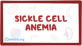 Sickle cell anemia  causes symptoms diagnosis treatment amp pathology [upl. by Nnawaj]