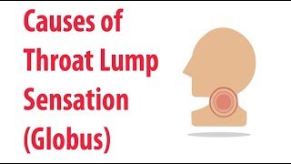 Causes of Throat Lump Sensation Globus [upl. by Ellitnahc330]