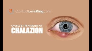 Chalazion  Causes Treatment and Surgery [upl. by Doty81]