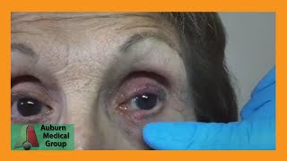 A Stye and a Chalazion  Auburn Medical Group [upl. by Dougall]