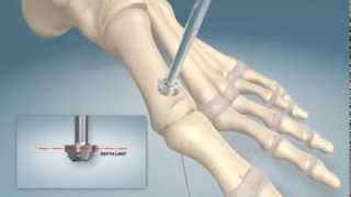 Matrix Meditec TTC Viva Ankle Arthrodesis Nail Surgical Technique [upl. by Baldwin]