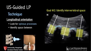 UltrasoundGuided Lumbar Puncture [upl. by Siduhey49]