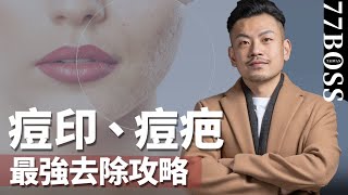 痘疤、痘斑怎麼消？最強攻略！【77老大】 [upl. by Brower]