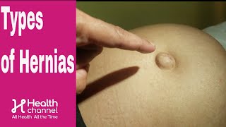 What is Hernia Symptoms Causes Types Treatment  Dr Harish N S  Doctors Circle [upl. by Ytsanyd]