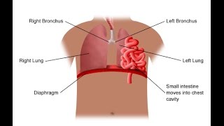 Diaphragmatic Hernia [upl. by Jenne]