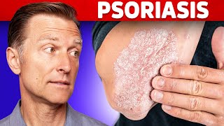 Psoriasis Treatment – The Best 3 Remedies for Psoriasis – DrBerg [upl. by Tiphani]