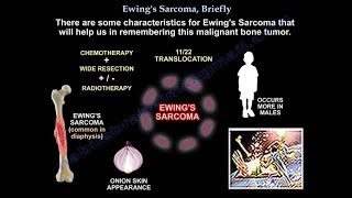 Ewings Sarcoma Briefly  Everything You Need To Know  Dr Nabil Ebraheim [upl. by Daven]