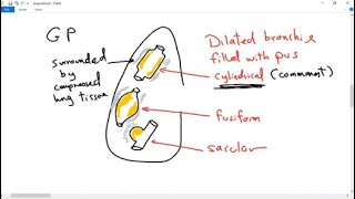 Spirometry Lung Volumes amp Capacities Restrictive amp Obstructive Diseases Animation [upl. by Tehr]