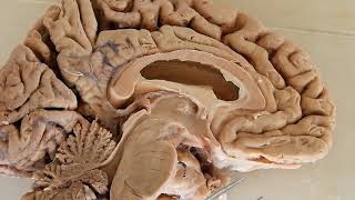 Third Ventricle  neuroanatomy  boundaries  recesses [upl. by Elijah61]