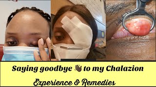 CHALAZION REMOVAL  EYE SURGERY MY EXPERIENCE amp REMEDIES [upl. by Toddy913]