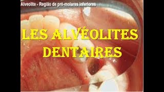 Les alvéolites dentaires [upl. by Eceinert]