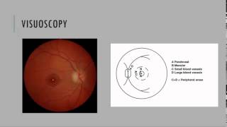 Visuoscopy Fixation Ophthalmoscopy [upl. by Yenduhc]