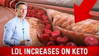 Cardiologist Dr Nadir Ali Explains LDL Bad Cholesterol Spike With Keto – DrBerg [upl. by Sira]