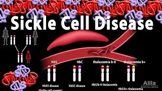 Sickle Cell Disease Animation [upl. by Aihtela]