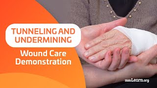 Tunneling and Undermining  Wound Care Demonstration [upl. by Irrem]