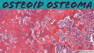 Osteoid Osteoma Bone Pathology Basics [upl. by Enawd]