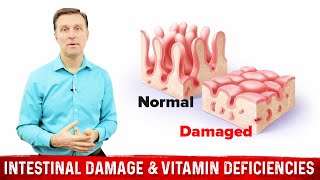 Intestinal Obstruction amp Vitamin Deficiencies – Dr Berg [upl. by Ciaphus]