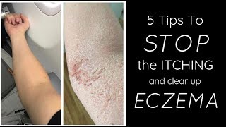 HEALING ECZEMA  5 Things I Do Each Day To STOP THE ITCH [upl. by Selda8]