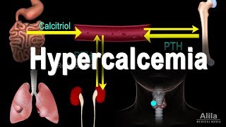 Hypercalcemia  Too Much Calcium Animation [upl. by Cutlerr]