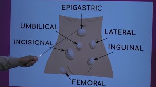 Types of Hernias [upl. by Adiol]