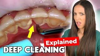 Dental Hygienist Explains Deep Cleaning Procedure [upl. by Naivart510]