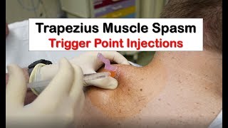 Trapezius Muscle Spasm Trigger Point Injection [upl. by Kylstra]