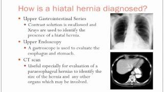 Hiatal Hernias [upl. by Okram]