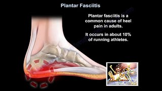 Plantar Fasciitis  Everything You Need To Know  Dr Nabil Ebraheim [upl. by Bank]