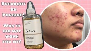 The Ordinary Glycolic Acid 7 Toning Solution Review [upl. by Sehguh984]