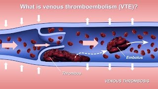 Understanding and Diagnosing Venous Thromboembolism VTE [upl. by Pennington]