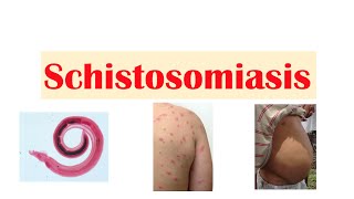 Schistosomiasis  Bilharziasis  Causes Symptoms and Treatment [upl. by Stearne]