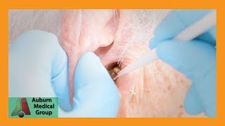 Chucks Tough Ear Wax Removal Part 1  Auburn Medical Group [upl. by Irrek267]